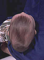 Sagittal Craniosynostosis