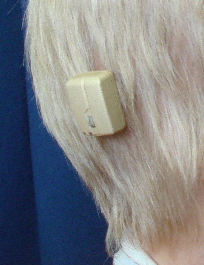 BAHA Hearing Aid