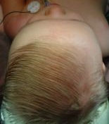 Plagiocephaly After
