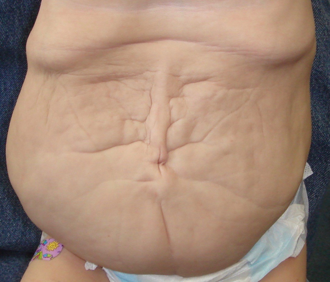 Prune Belly Syndrome
