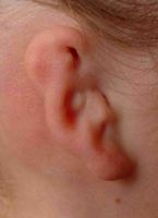 Ear Reconstruction Stage 1