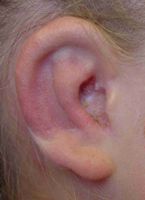 Ear Reconstruction Stage 3 Final