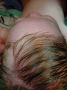 Trigonocephaly After