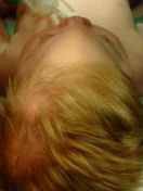 Trigonocephaly Before